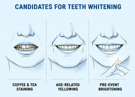 Common indications for teeth whitening such as tea/coffee stains, age-related yellowing, and pre-event brightening
